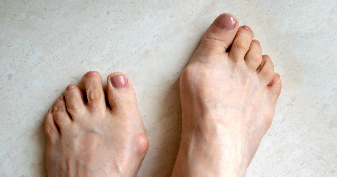 hallux valgus